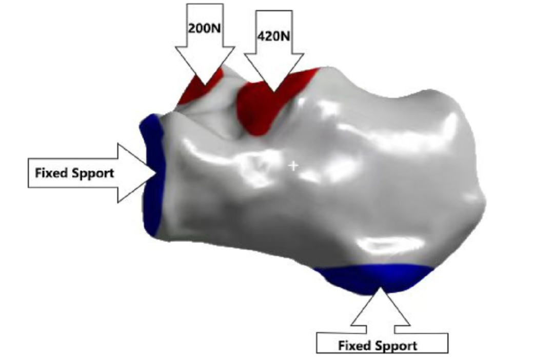 跟骨骨折：微创经皮螺钉固定的最佳螺钉分布及直径