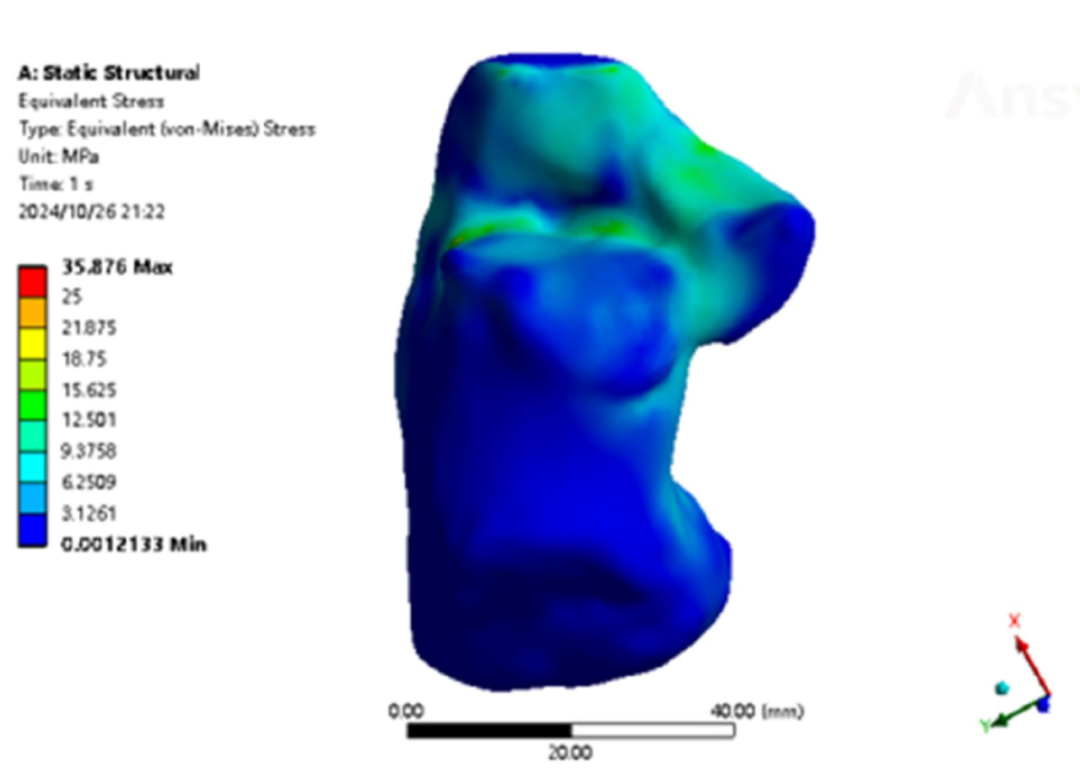 跟骨骨折：微创经皮螺钉固定的最佳螺钉分布及直径