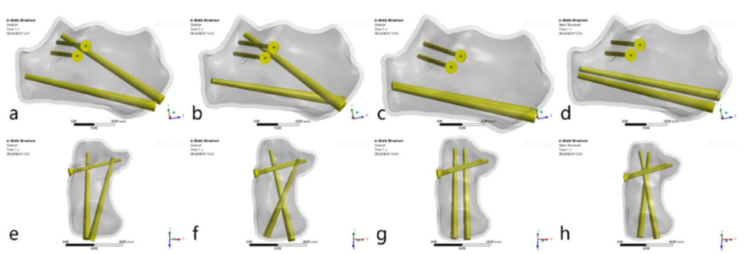 跟骨骨折：微创经皮螺钉固定的最佳螺钉分布及直径