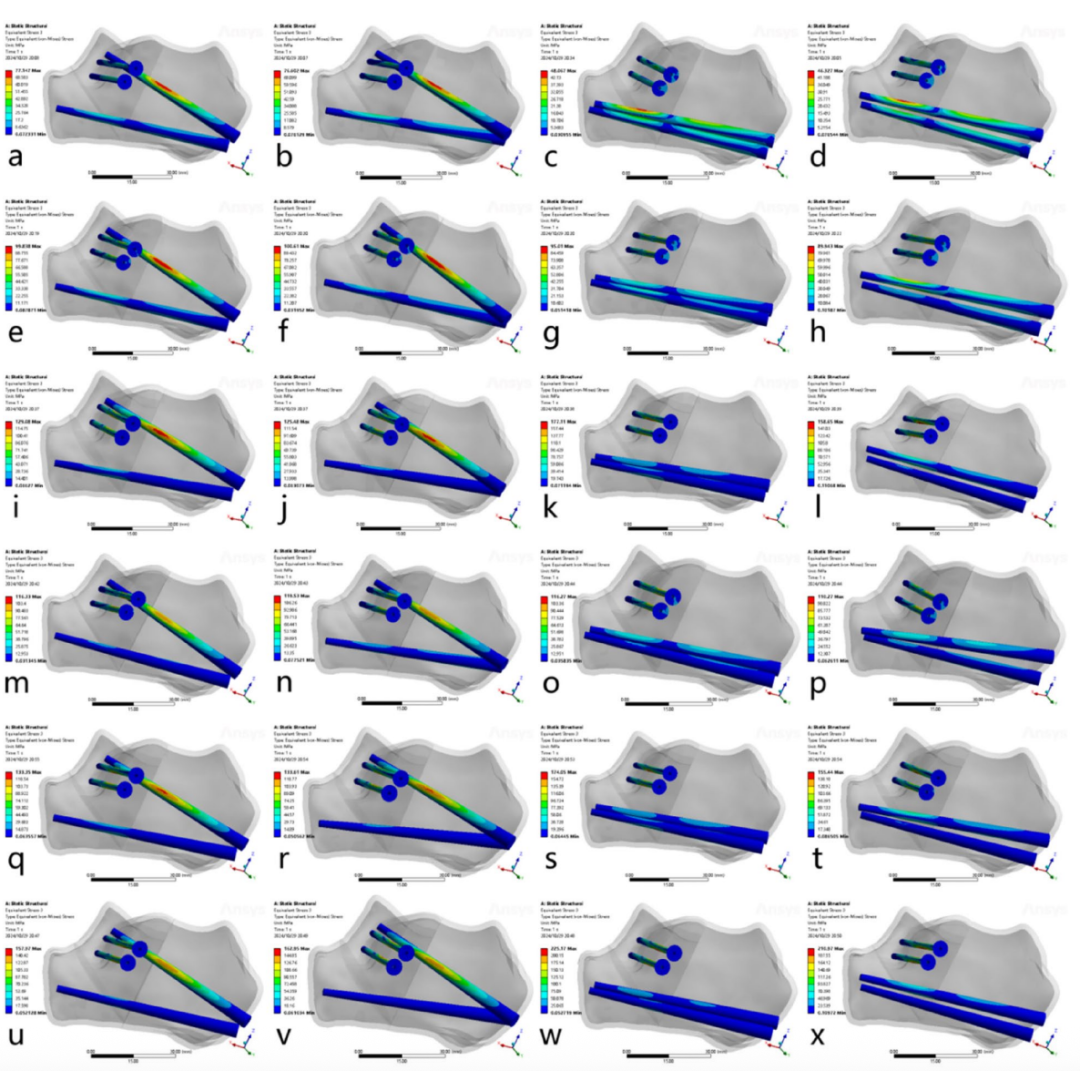 跟骨骨折：微创经皮螺钉固定的最佳螺钉分布及直径