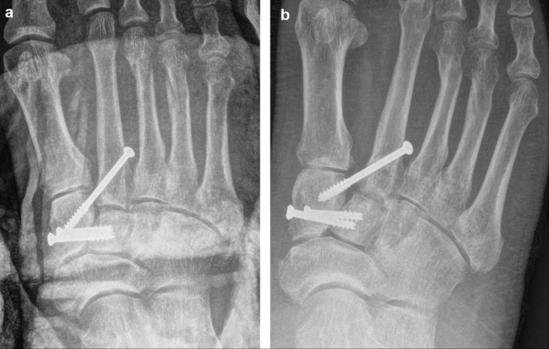 Lisfranc损伤螺钉固定后复位丢失：螺钉类型是否有影响？