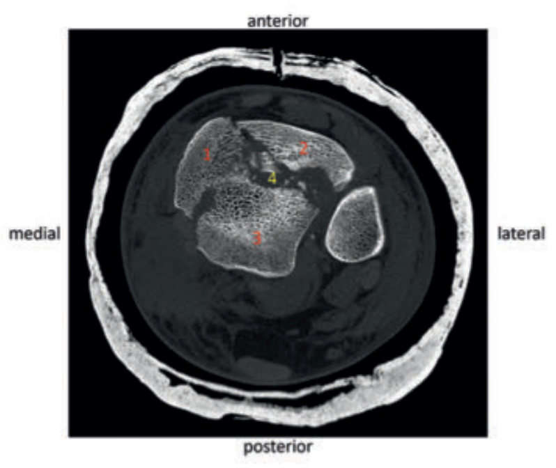Pilon骨折：最新诊断与治疗策略
