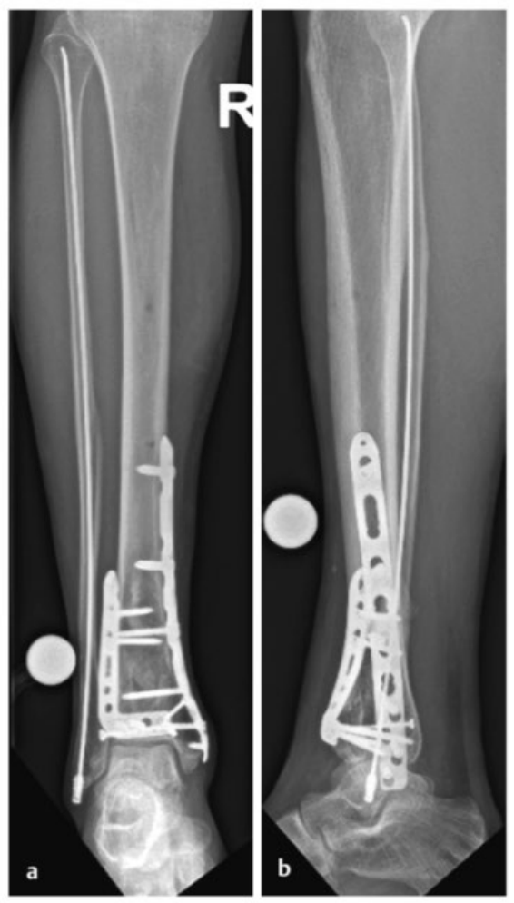 Pilon骨折：最新诊断与治疗策略