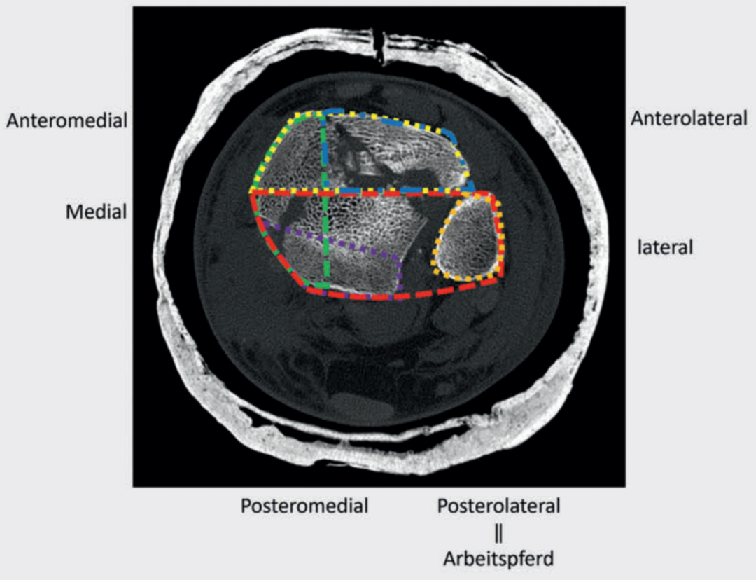 Pilon骨折：最新诊断与治疗策略