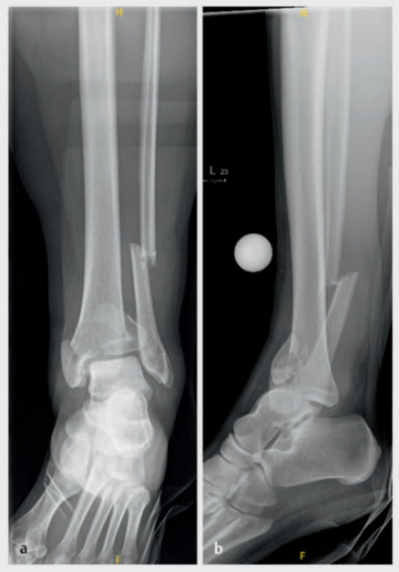 Pilon骨折：最新诊断与治疗策略