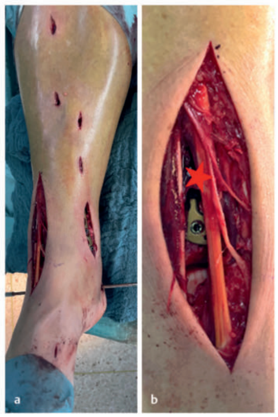 Pilon骨折：最新诊断与治疗策略