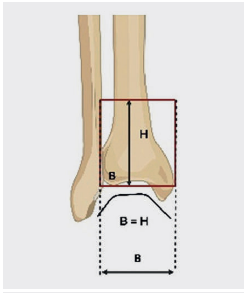 Pilon骨折：最新诊断与治疗策略