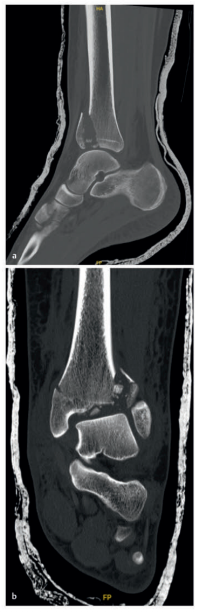 Pilon骨折：最新诊断与治疗策略