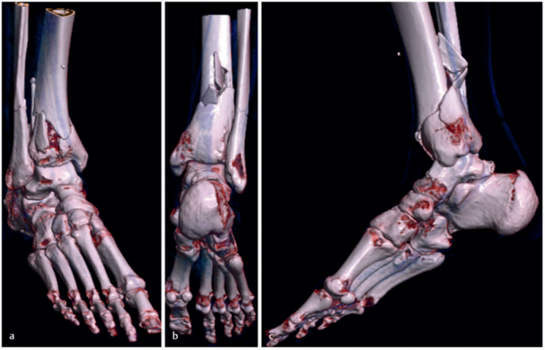 Pilon骨折：最新诊断与治疗策略
