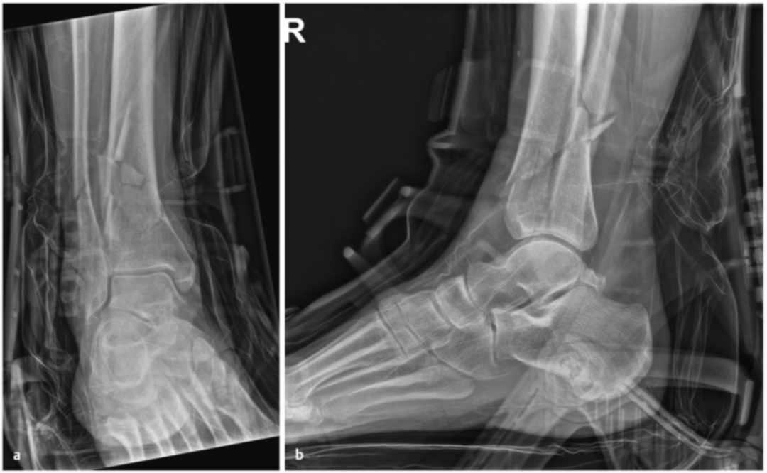 Pilon骨折：最新诊断与治疗策略