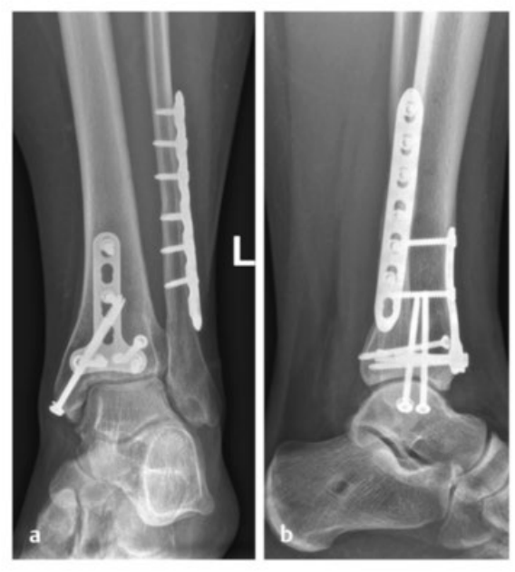 Pilon骨折：最新诊断与治疗策略