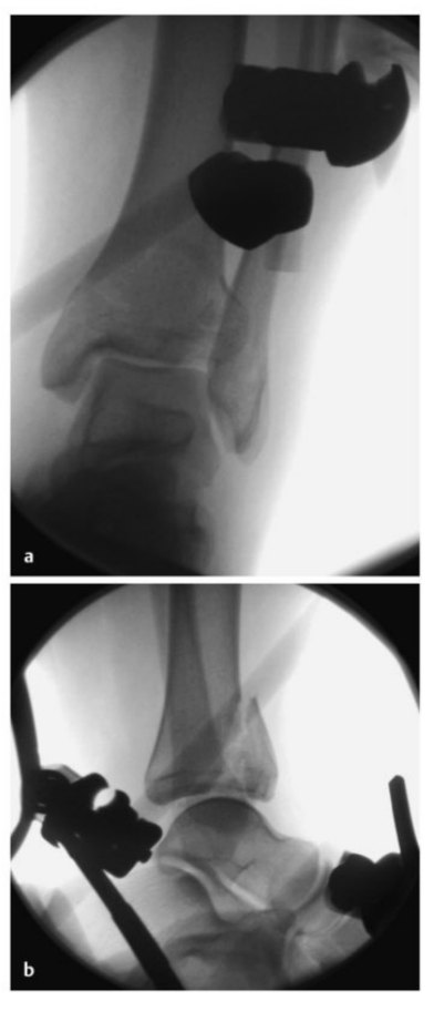 Pilon骨折：最新诊断与治疗策略