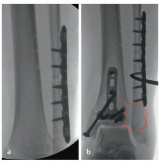 Pilon骨折：最新诊断与治疗策略
