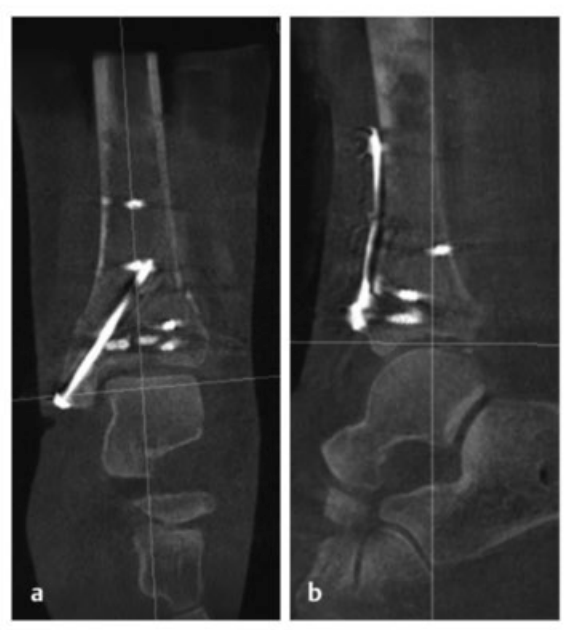 Pilon骨折：最新诊断与治疗策略
