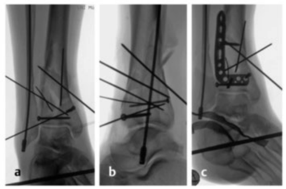 Pilon骨折：最新诊断与治疗策略