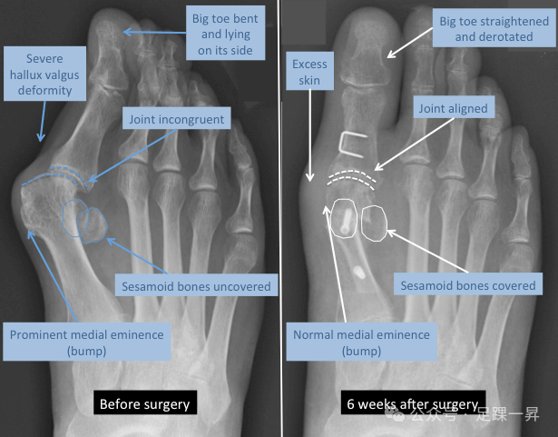 压舌板用纱布怎么包拇外翻｜术后压舌板敷料包扎技术_https://www.jmylbn.com_新闻资讯_第2张