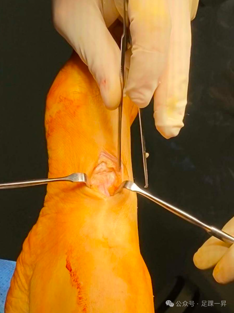 手术技巧｜Cotton截骨术