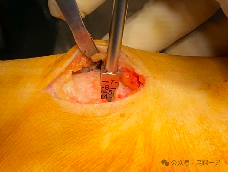 手术技巧｜Cotton截骨术