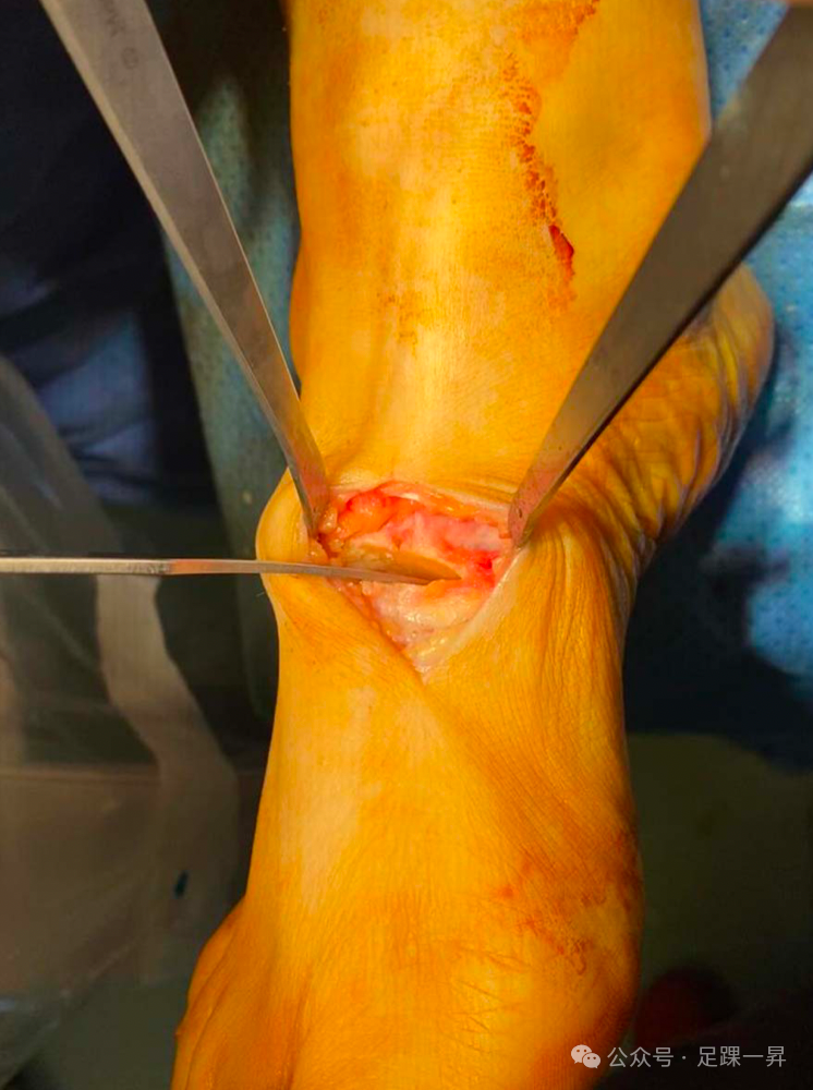 手术技巧｜Cotton截骨术
