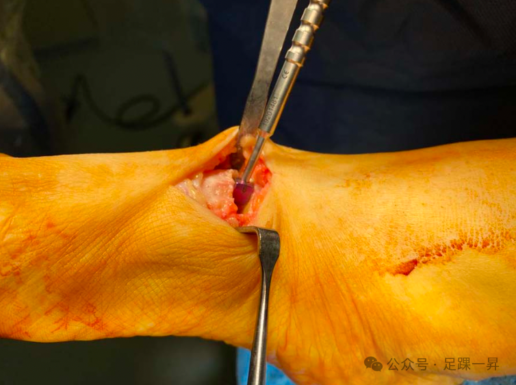 手术技巧｜Cotton截骨术