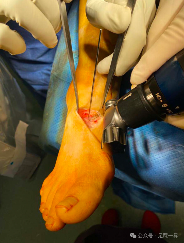 手术技巧｜Cotton截骨术