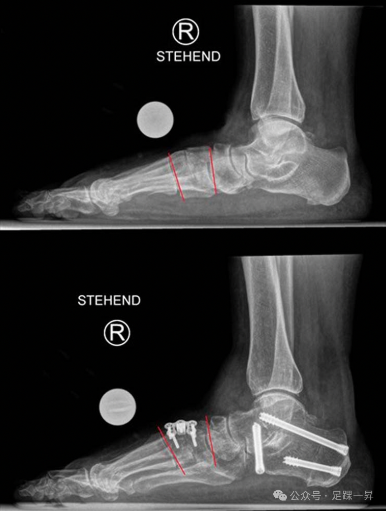 手术技巧｜Cotton截骨术
