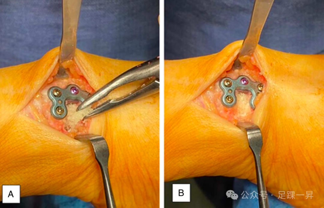 手术技巧｜Cotton截骨术