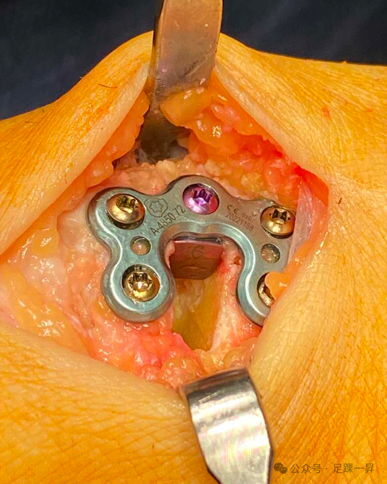 手术技巧｜Cotton截骨术