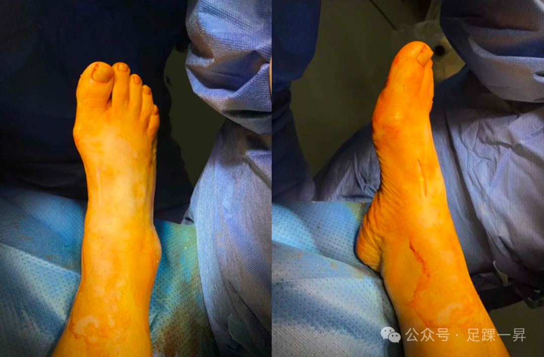 手术技巧｜Cotton截骨术