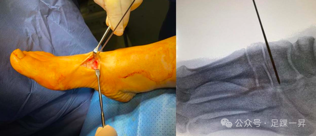 手术技巧｜Cotton截骨术