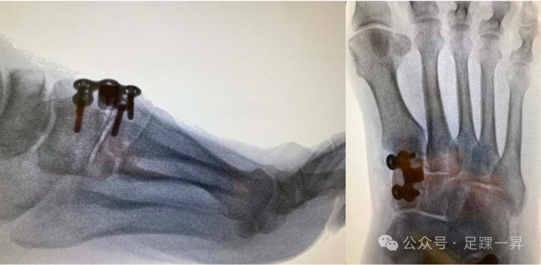 手术技巧｜Cotton截骨术