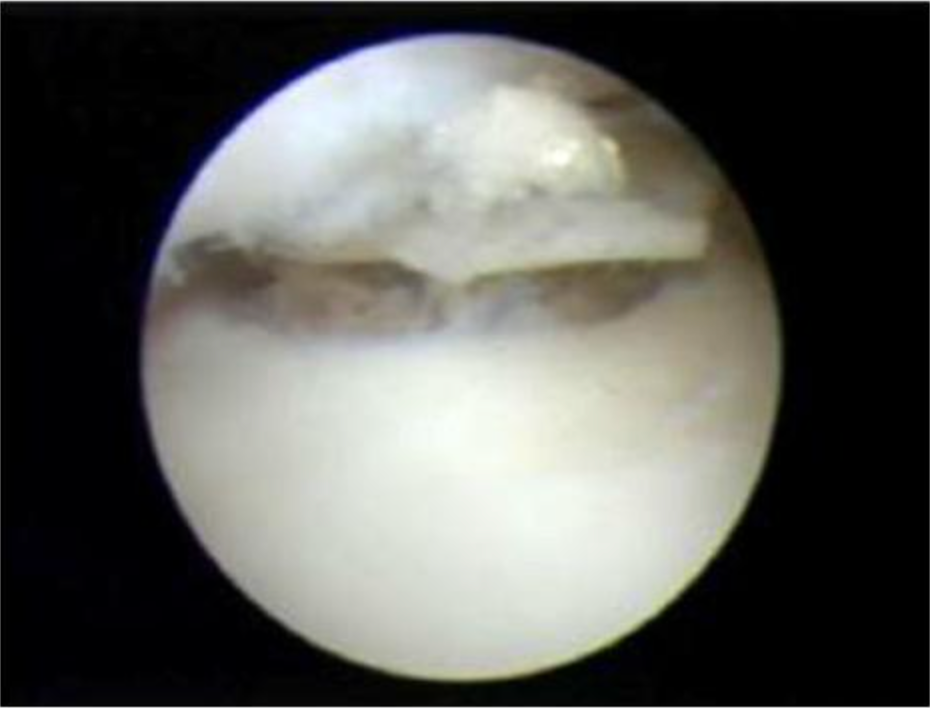 距骨骨软骨手术德国经验｜软骨成形术、逆行钻孔、微骨折术