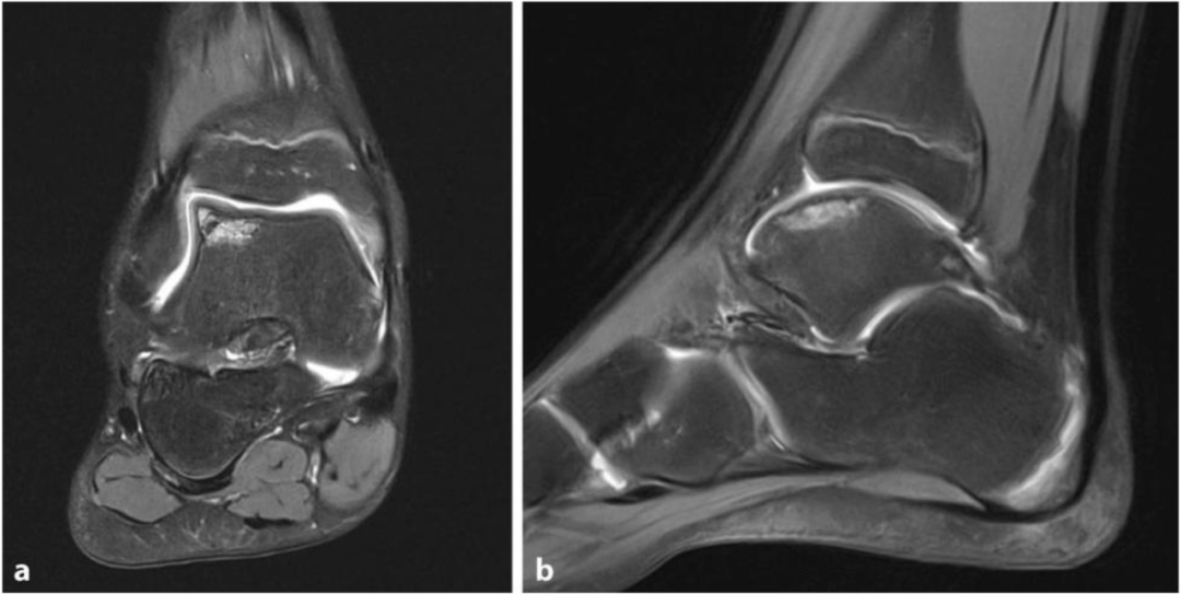 距骨骨软骨手术德国经验｜软骨成形术、逆行钻孔、微骨折术