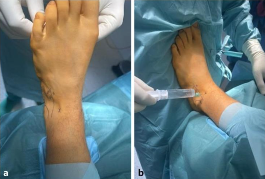 距骨骨软骨手术德国经验｜软骨成形术、逆行钻孔、微骨折术