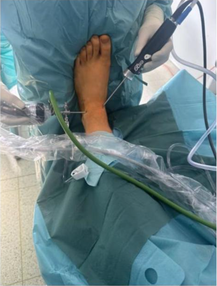 距骨骨软骨手术德国经验｜软骨成形术、逆行钻孔、微骨折术