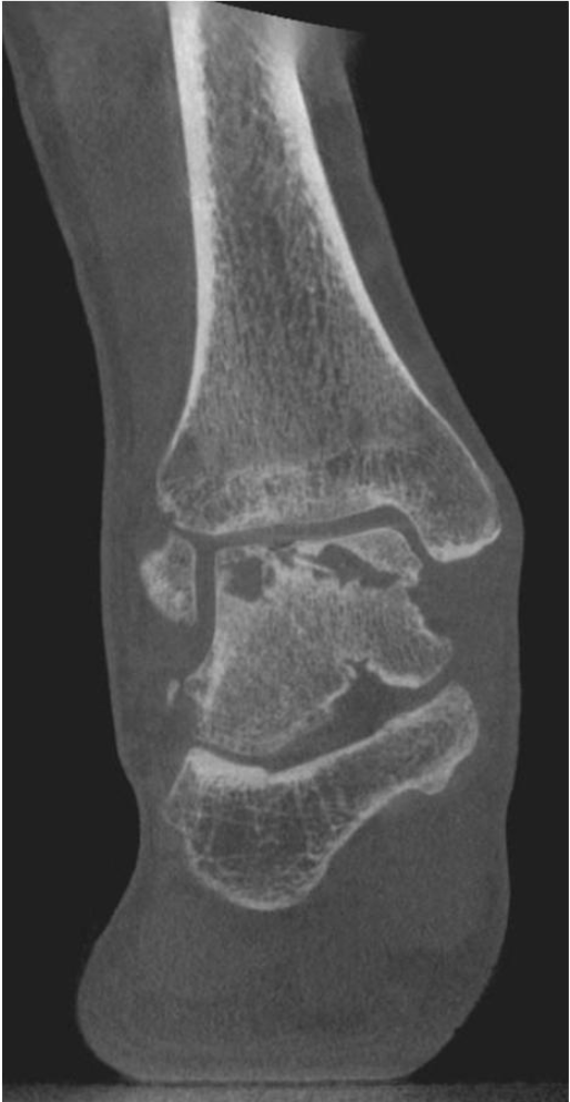 距骨骨软骨手术德国经验｜软骨成形术、逆行钻孔、微骨折术
