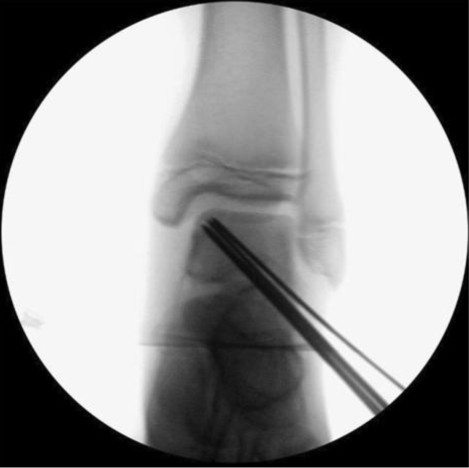 距骨骨软骨手术德国经验｜软骨成形术、逆行钻孔、微骨折术