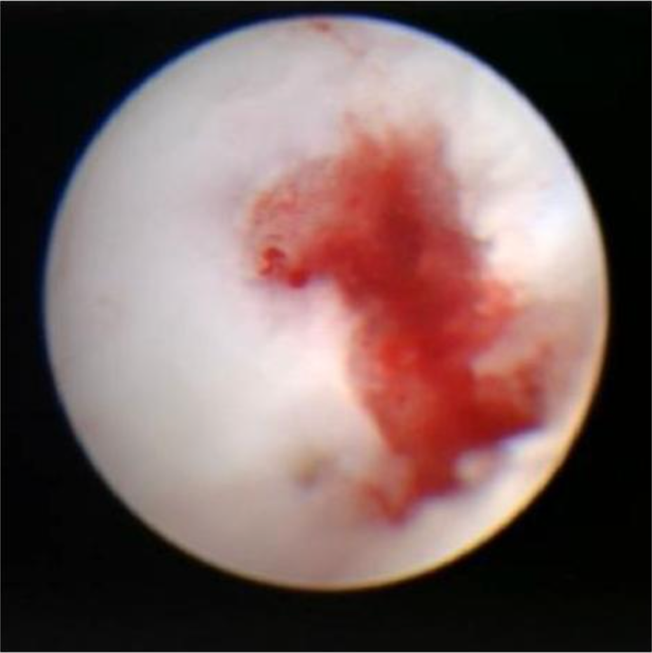 距骨骨软骨手术德国经验｜软骨成形术、逆行钻孔、微骨折术