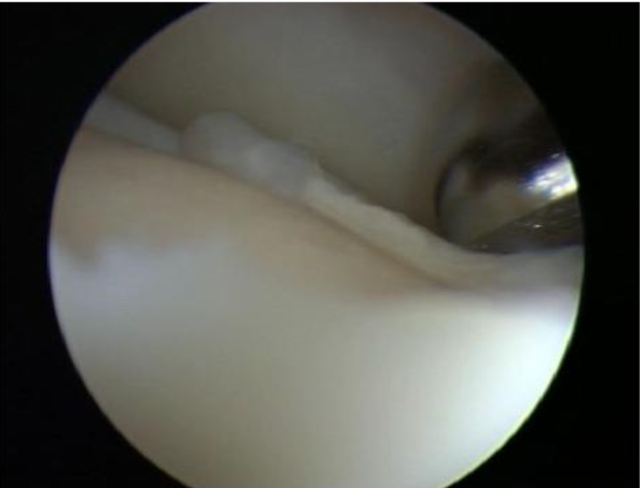 距骨骨软骨手术德国经验｜软骨成形术、逆行钻孔、微骨折术