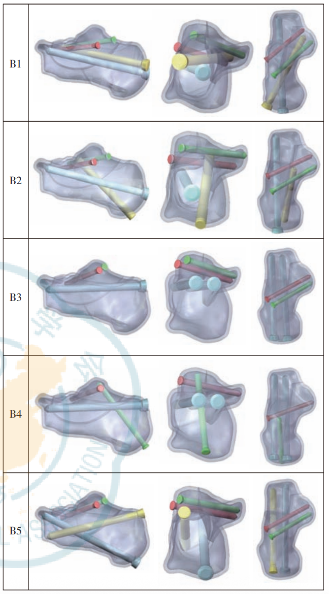 跟骨骨折：微创经皮螺钉固定的最佳螺钉分布及直径