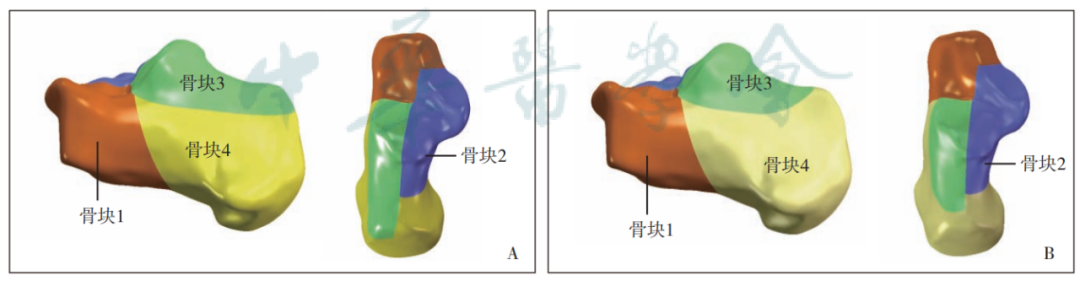 跟骨骨折：微创经皮螺钉固定的最佳螺钉分布及直径
