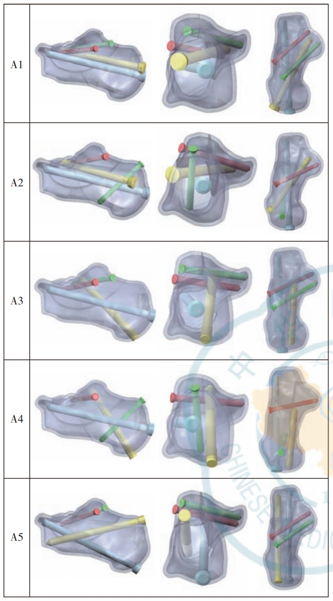 跟骨骨折：微创经皮螺钉固定的最佳螺钉分布及直径