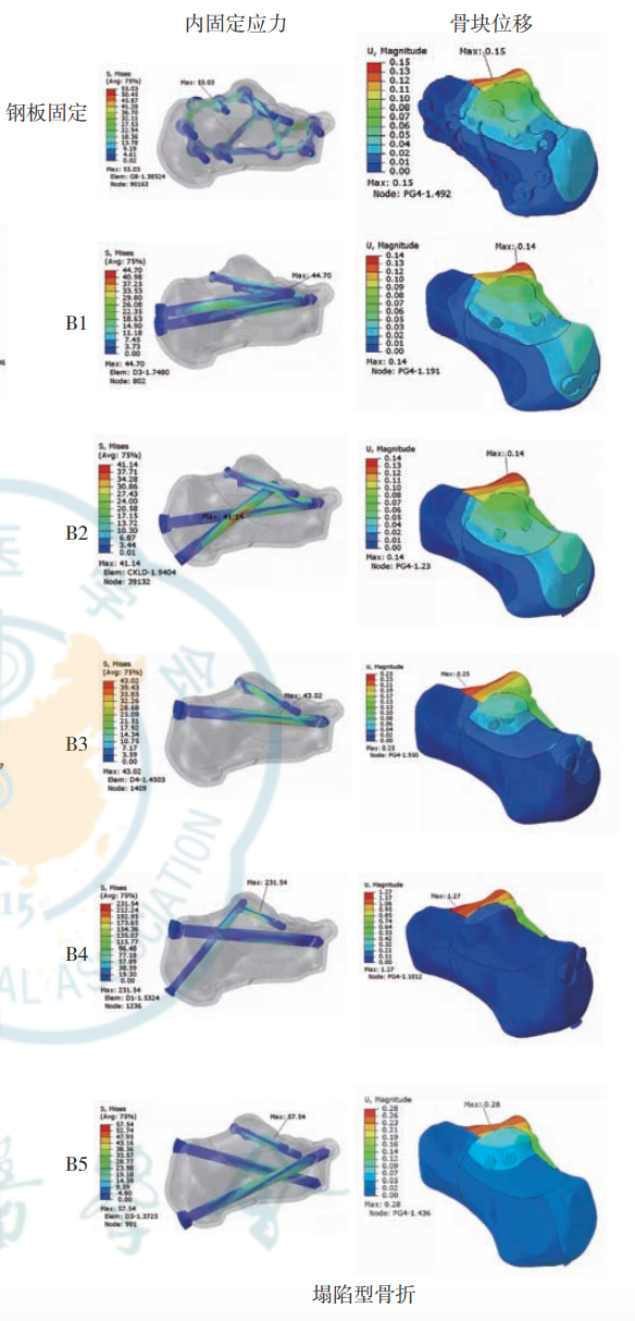 跟骨骨折：微创经皮螺钉固定的最佳螺钉分布及直径