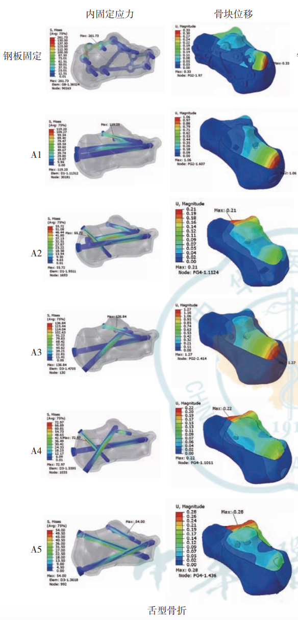 跟骨骨折：微创经皮螺钉固定的最佳螺钉分布及直径