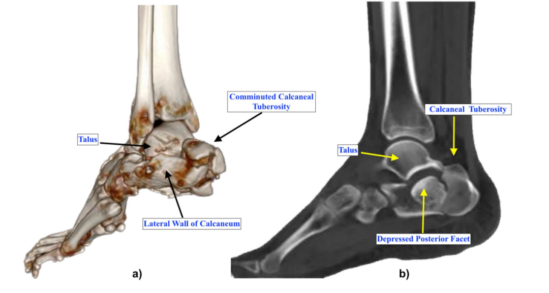 【手术技巧】跟骨骨折经皮复位新技术（印度经验）