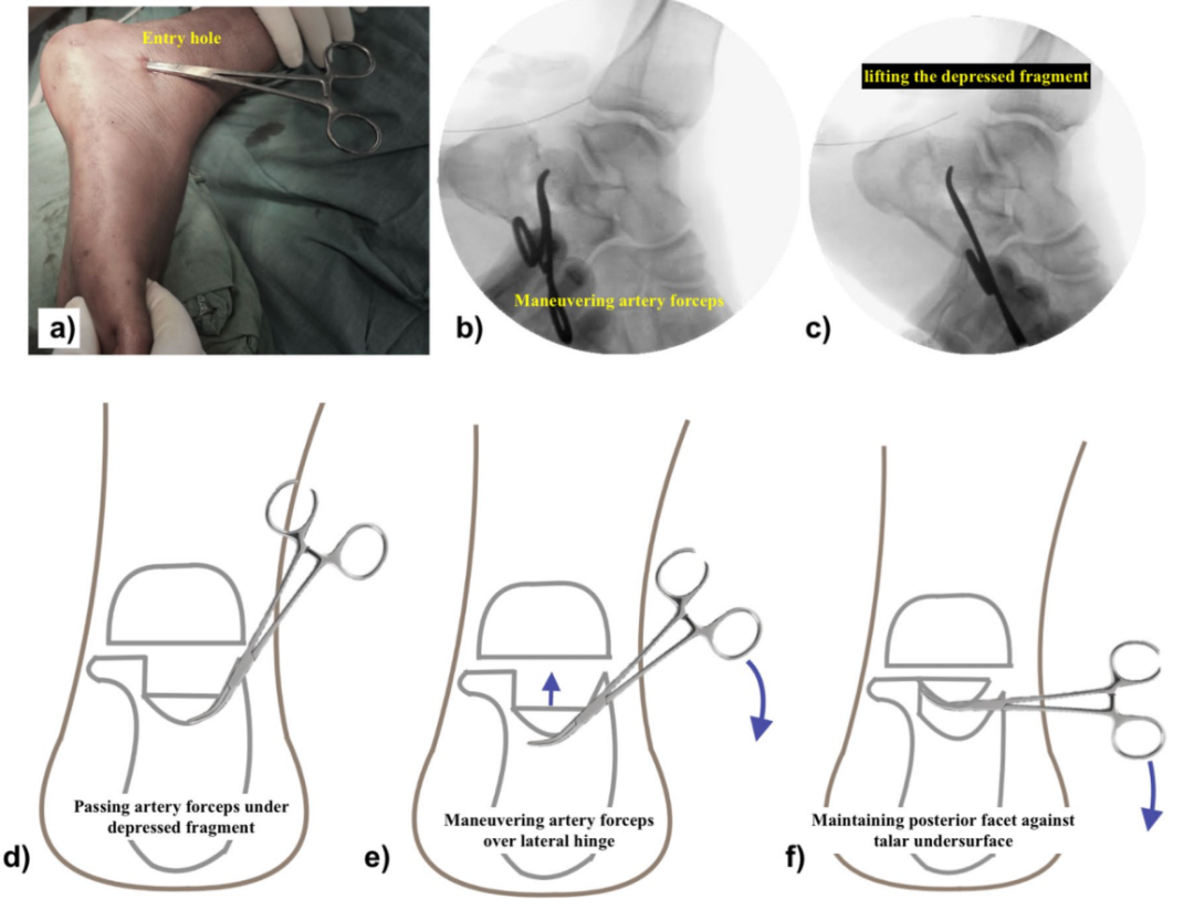 【手术技巧】跟骨骨折经皮复位新技术（印度经验）