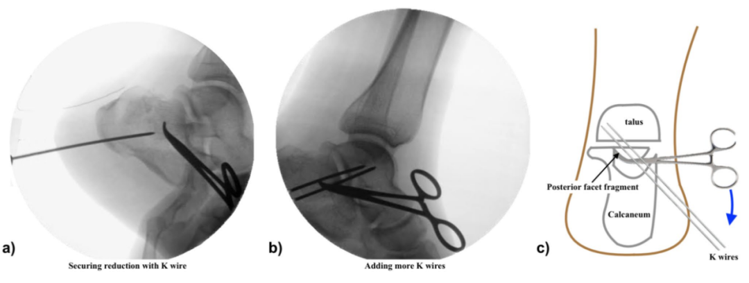 【手术技巧】跟骨骨折经皮复位新技术（印度经验）