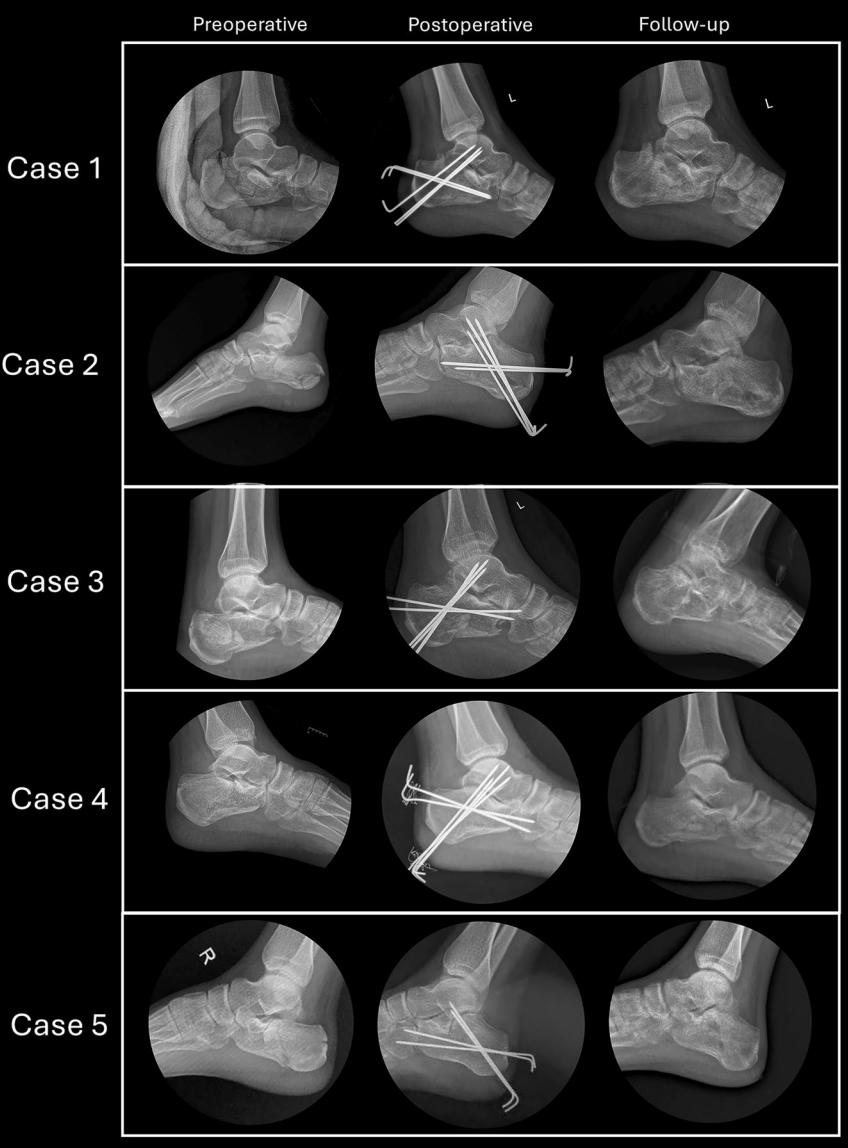 【手术技巧】跟骨骨折经皮复位新技术（印度经验）