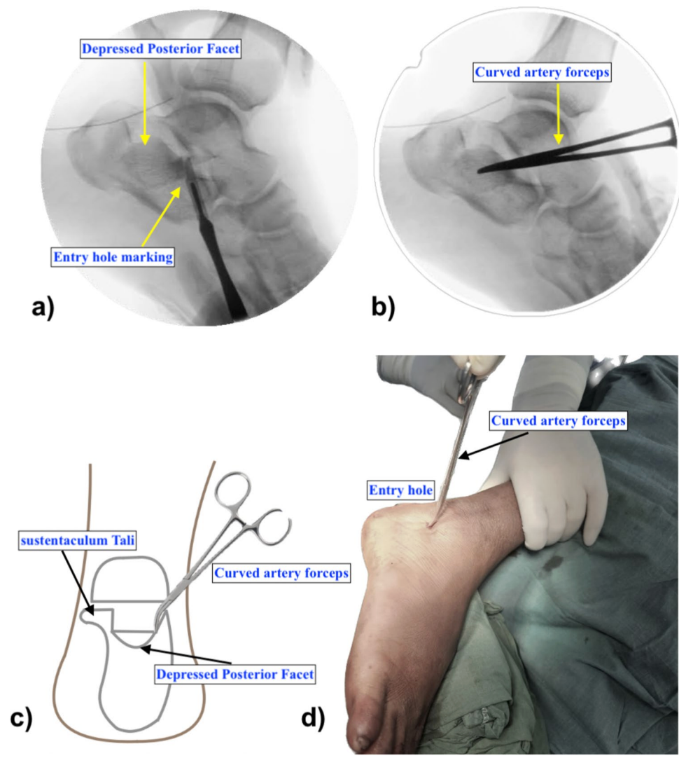 【手术技巧】跟骨骨折经皮复位新技术（印度经验）