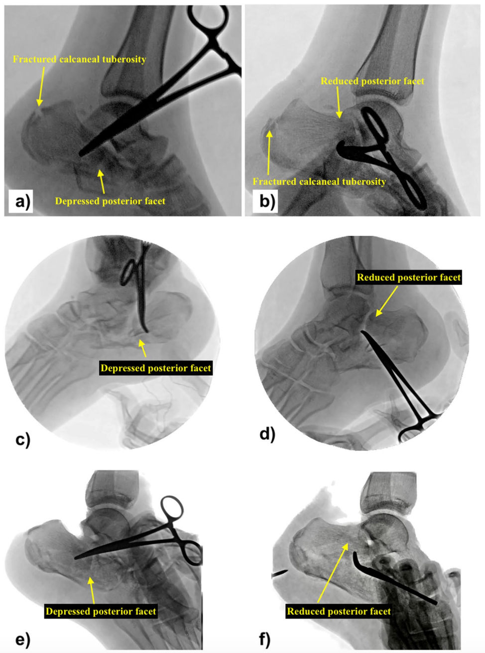 【手术技巧】跟骨骨折经皮复位新技术（印度经验）